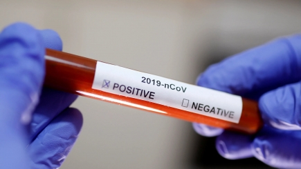 Penkios laboratorijos atlieka mokamus tyrimus koronavirusinei infekcijai nustatyti