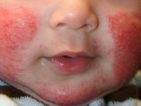 Atopinis dermatitas: kodėl būtina alergologo pagalba